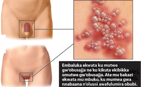 Embaluka ekwata ku mutwe gw’obusajja ne ku kikuta ekibikka omutwe gw’obusajja. Ate mu bakazi ekwata mu mbuko, ku mumwa gwa nnabaana n’oluusi awafulumira obubi. Embaluka ekwata ku mutwe gw’obusajja ne ku kikuta ekibikka omutwe gw’obusajja. Ate mu bakazi ekwata mu mbuko, ku mumwa gwa nnabaana n’oluusi awafulumira obubi.