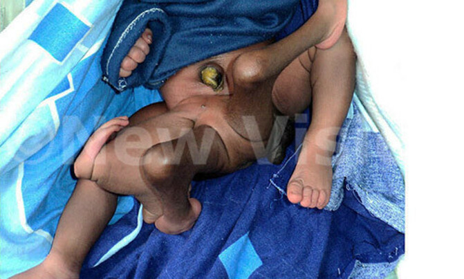 Baby with extra limbs was meant to be Siamese twin Baby with extra limbs was meant to be Siamese twin