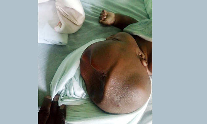 Children with spina bifida, hydrocephalus lack medical supplies Children with spina bifida, hydrocephalus lack medical supplies