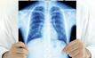 Free lung tests for QLD miners