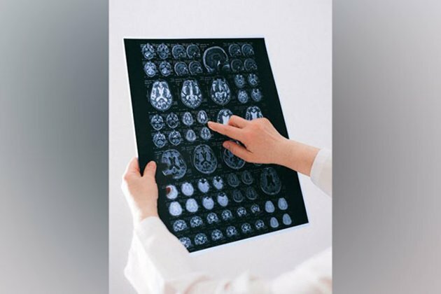 Brain map clarifies neuronal connectivity behind motor function: Study
