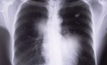 Peabody reviews its black lung response