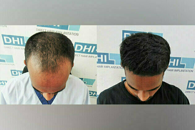 Exclusive Technique Now Available Only in DHI's Authorized Clinics