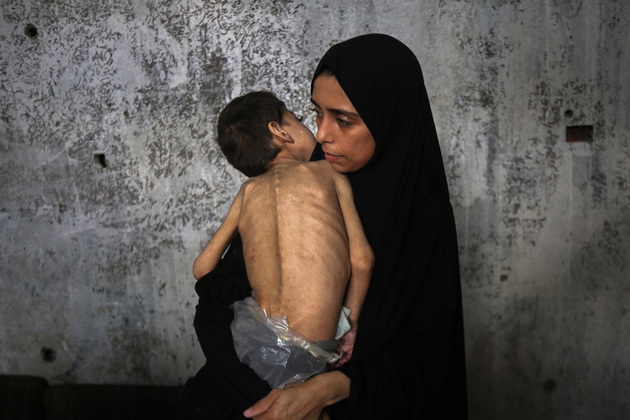MIDEAST-GAZA CITY-CHILDREN-MALNUTRITION