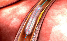 Gyrus buys LivaNova heart valve business for €60m