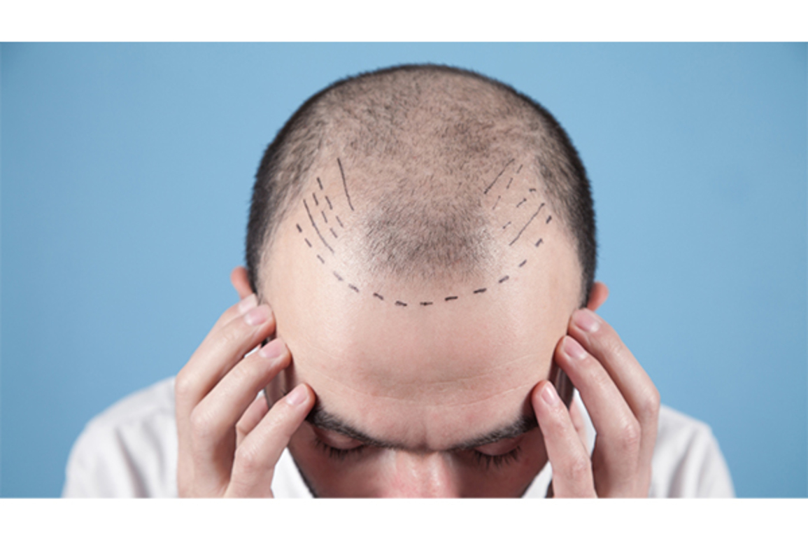 Dermatologist vs. Hair Transplant Surgeon: Who's Best for Hair Transplant Surgery?