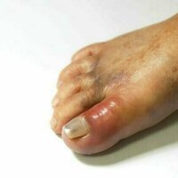 Gout used to be an affliction of royalty but is now a disease of the masses