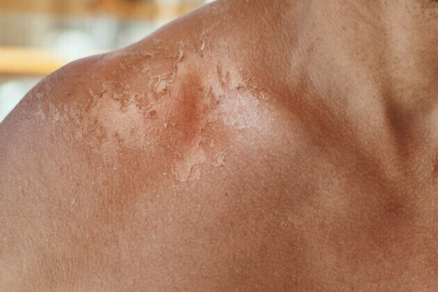 Skin injuries spike during heat waves in India