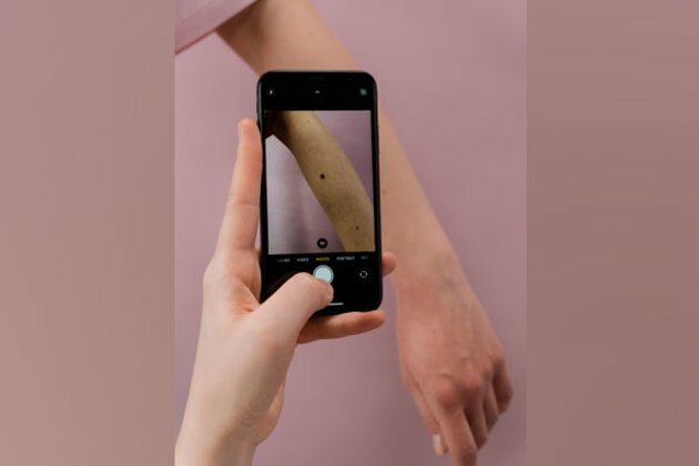 Researchers study why moles become melanomas