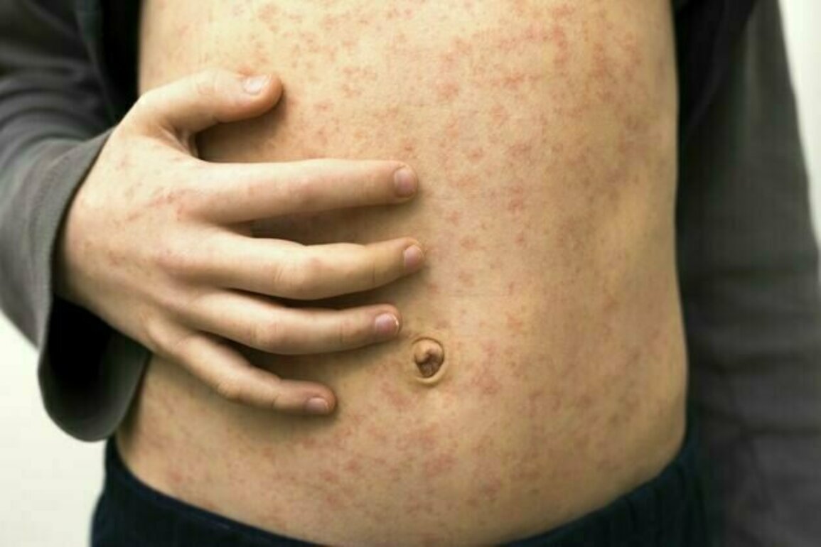 Texas records first US measles death in 10 years - a medical epidemiologist explains how to protect yourself and your community from this deadly, preventable disease