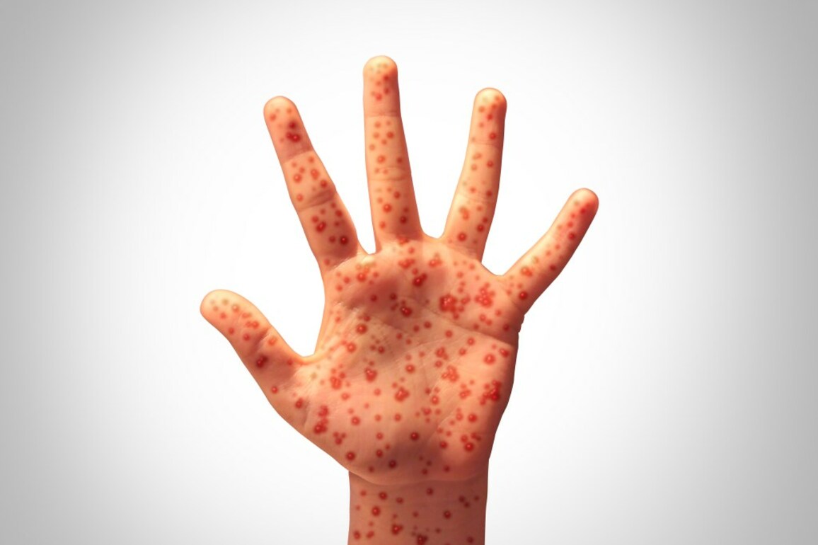 Editorial- Pueblo measles case is reason to revisit vaccine, MMR risks