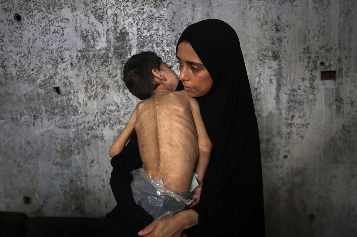 MIDEAST-GAZA CITY-CHILDREN-MALNUTRITION