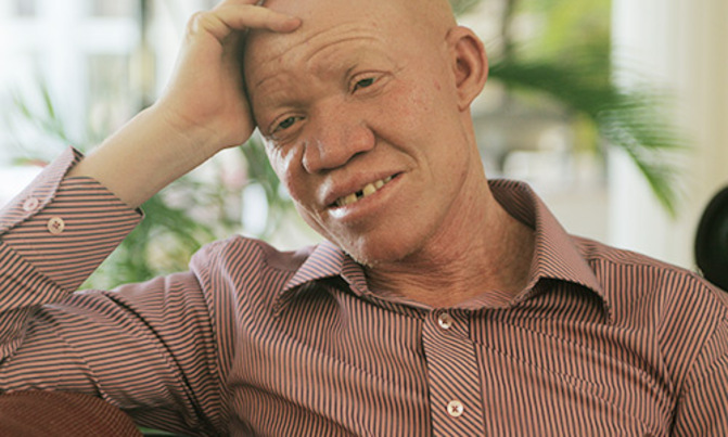 Tanzanian albinos terrified after attacks Tanzanian albinos terrified after attacks