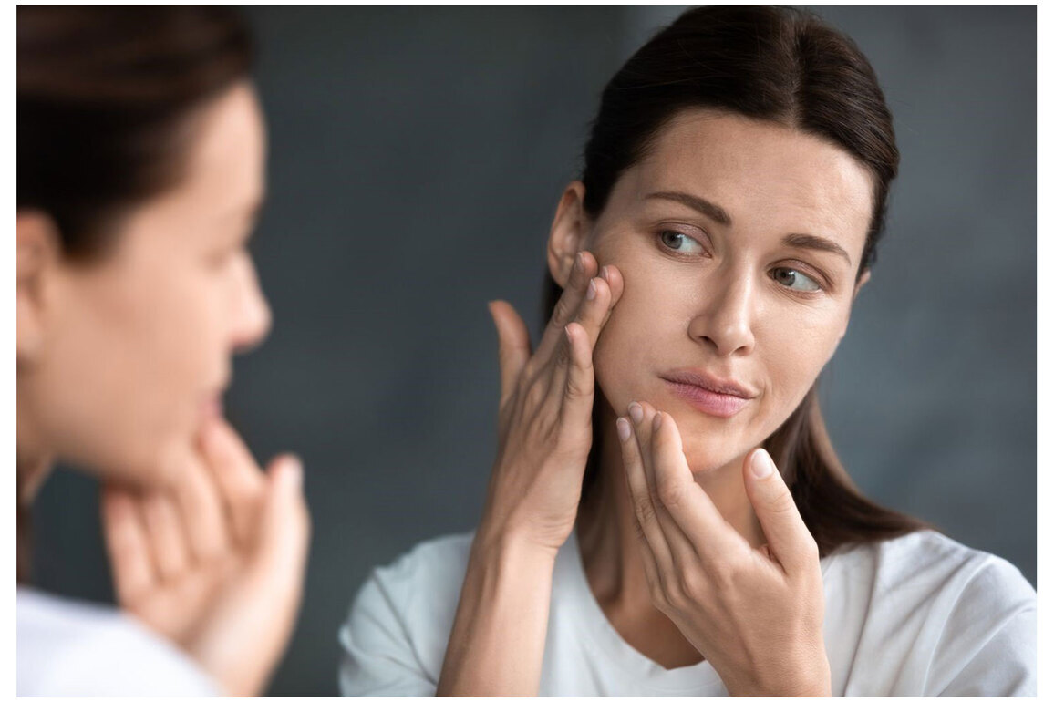 Why Traditional Acne Treatments Fail Women with PCOS