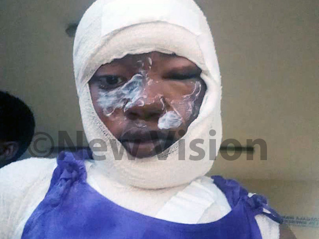  uhooza at iruddu hospital where she is nursing acid burns hoto by ackie ambogga