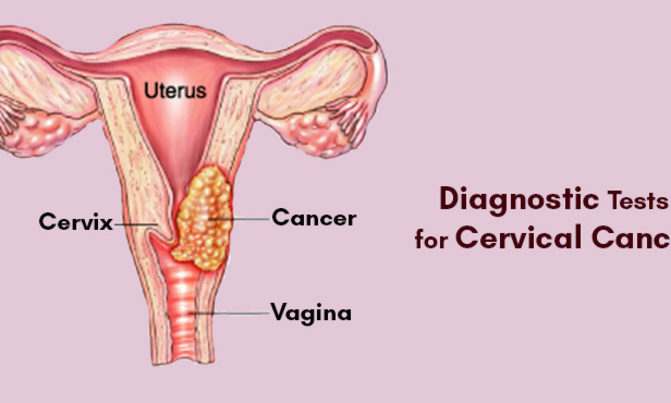 Cervical cancer gene discovery may boost remedy quest Cervical cancer gene discovery may boost remedy quest