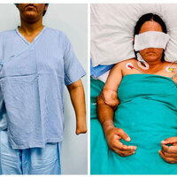 Hand Transplant gives new life to young mother who lost both hands in chaff-cutting machine accident