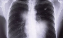 Aussie radiologists to be trained in black lung detection