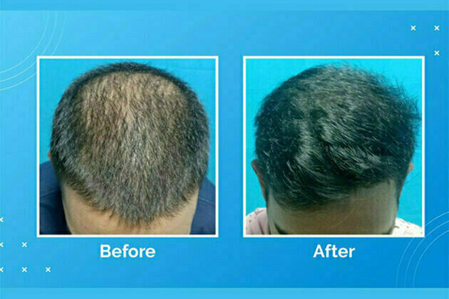 VCare's treatment for hair loss and hair thinning