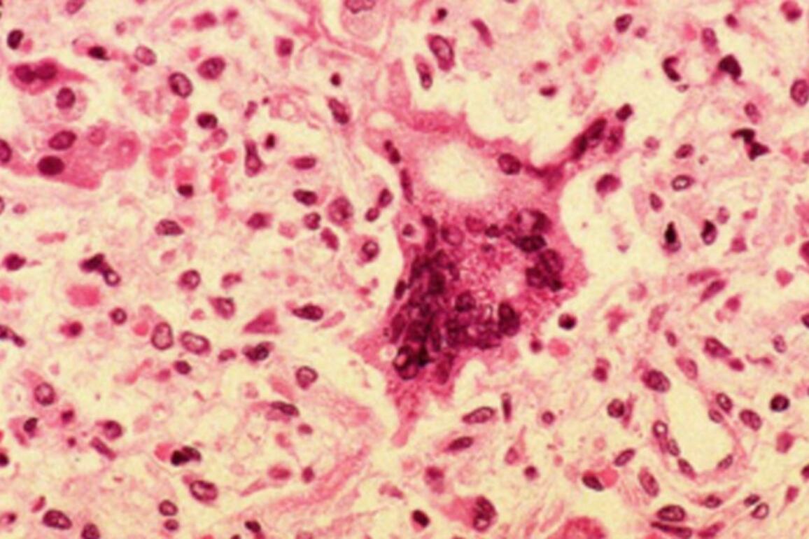 Public urged to watch for measles symptoms after new cases emerge in WA