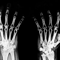 What's the difference between osteoarthritis and rheumatoid arthritis?