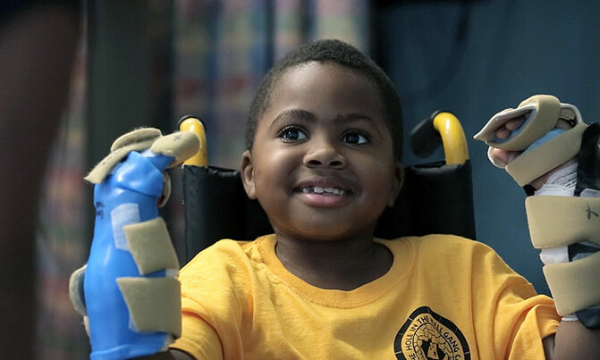 World's first child hand transplant a 'success' World's first child hand transplant a 'success'