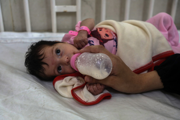 MIDEAST-GAZA CITY-HUNGER-MALNUTRITION