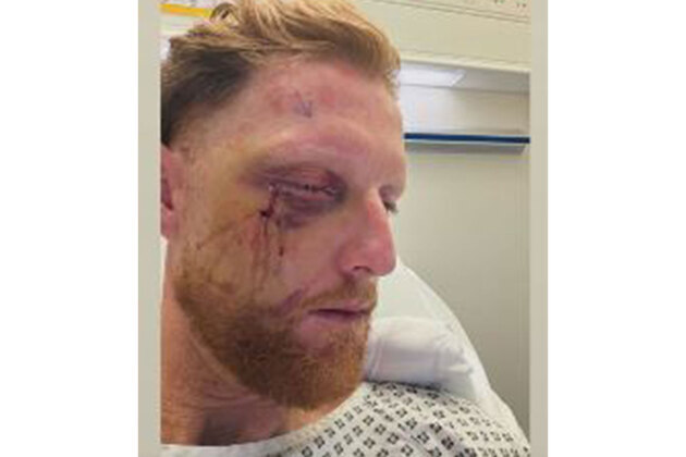 England Test captain Ben Stokes undergoes successful facial surgery