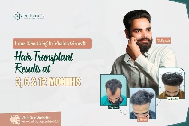 From Shedding to Visible Growth: Hair Transplant Results at 3, 6 and 12 Months