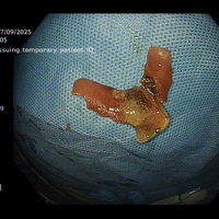 Laser to the rescue: Delhi doctors vaporise stuck denture to save patient from major surgery