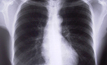 Qld black lung cases spark safety concerns