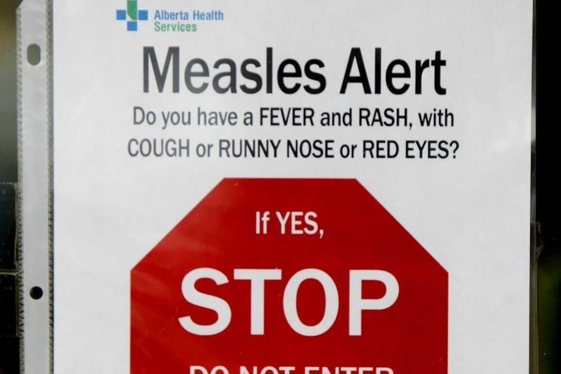 Another measles alert for Edmonton area after case at Spruce Grove clinic