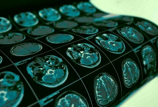 Studies of Parkinson's disease have long overlooked Pacific populations - our work shows why that must change