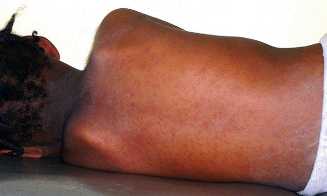 WHO warns of 'backsliding' in measles fight as cases soar WHO warns of 'backsliding' in measles fight as cases soar
