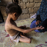 MIDEAST-GAZA CITY-CHILD-MALNUTRITION