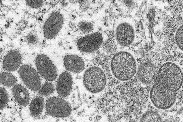 Khyber Pakhtunkhwa reports 8th mpox case of 2025