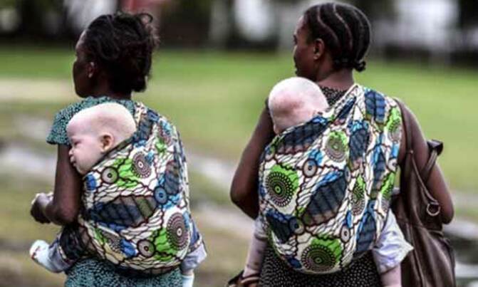 Mutilated Tanzanian albino baby body found Mutilated Tanzanian albino baby body found