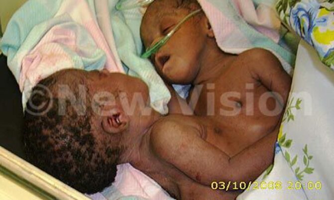 Mbarara conjoined twins dead Mbarara conjoined twins dead