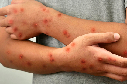 New York health department confirms first case of new mpox strain