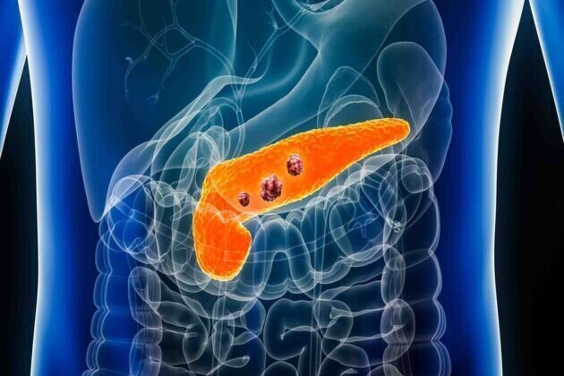Promising US drug offers hope for pancreatic cancer patients