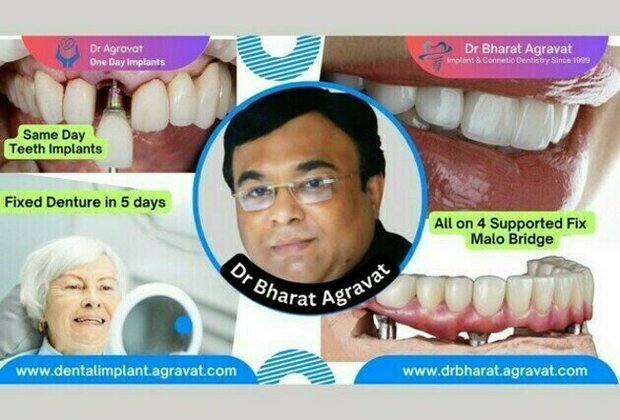 Best Dentist for Full Mouth Dental Implants Clinic in Ahmedabad: Dr. Bharat Agravat, the top Implantologist