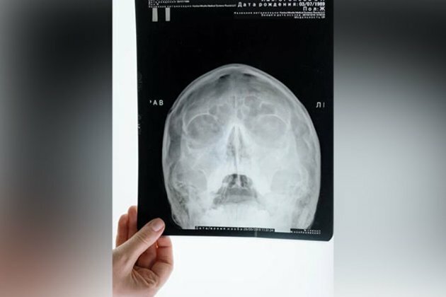Surgery can be avoided for children with rare skull tumor: Study