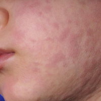 Illinois health officials confirm two measles cases in Cook County