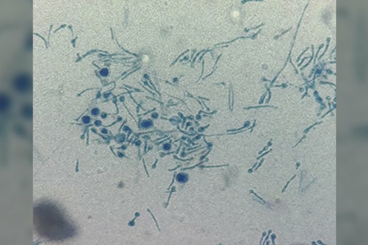 Plant fungus infects humans report
