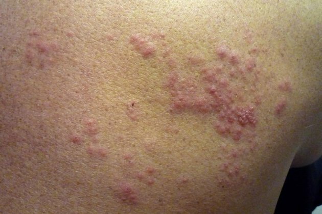 Researchers discover vaccine to treat herpes