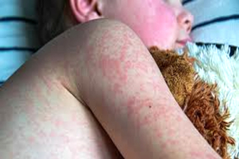 US measles cases surpass 1,000 for first time in 5 years