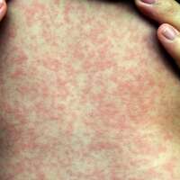 18 cases of measles reported in northern B.C., officials say