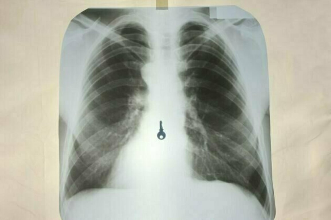 From Tiffany earrings to mobile phones - this is what happens when you swallow something you shouldn't