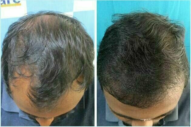 VCare's Hair Transplantation Ensures To Completely Reverse Baldness