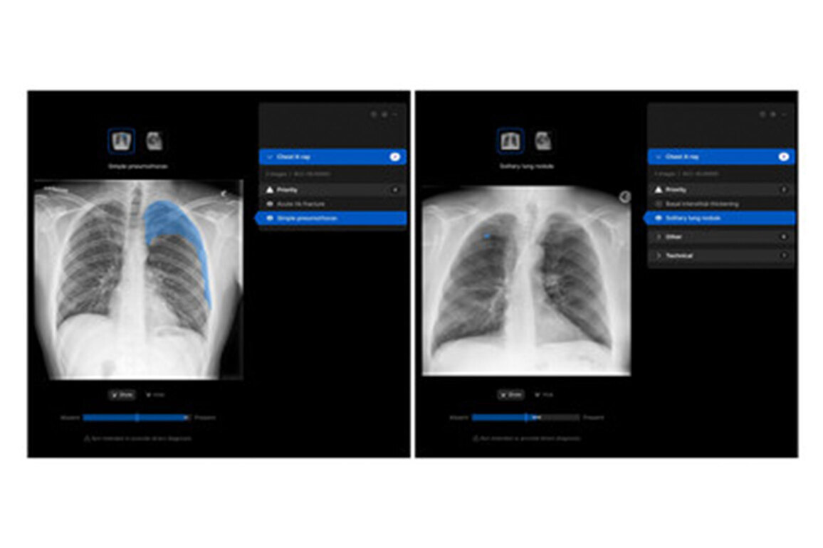 Manipal Hospitals Adopts Harrison.ai's chest X-ray AI to improve patient outcomes